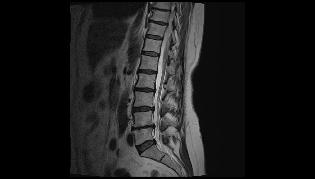 Diagnosi del mal di schiena nella regione lombare