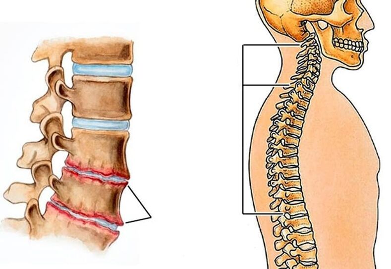 La curvatura della colonna vertebrale porta al mal di schiena