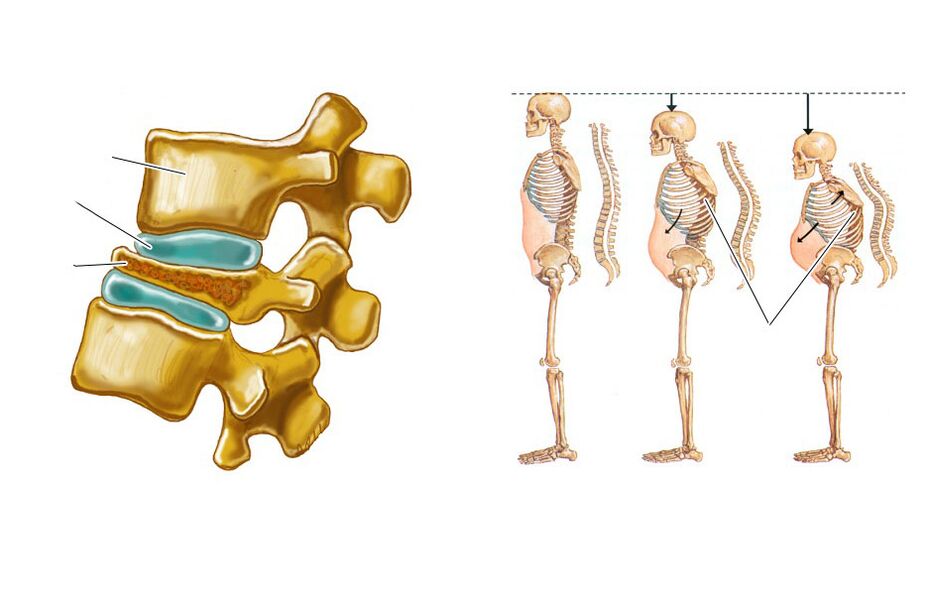 una colonna vertebrale cadente porta al mal di schiena