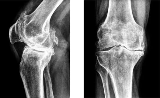 Radiografia della gonartrosi del ginocchio