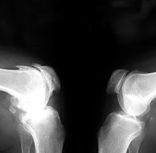 Osteoartrite su x-ray