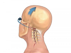 come si manifesta l'osteocondrosi del rachide cervicale