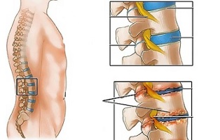 Cause di osteocondrosi della colonna lombare