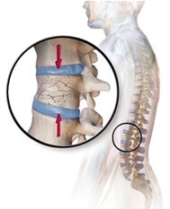 L'osteoporosi provoca mal di schiena nella zona lombare