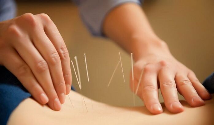 Agopuntura usata per trattare il mal di schiena